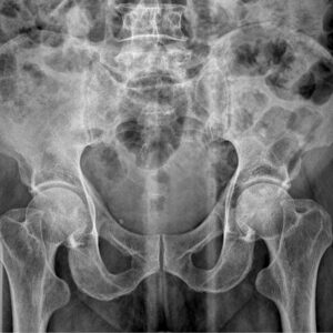 Biomet Hip Lawsuit Filed Over Defective M2A Metal-on-Metal Implant