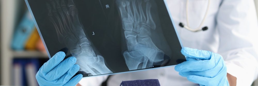 Cartiva-Toe-Implant-Lawsuit