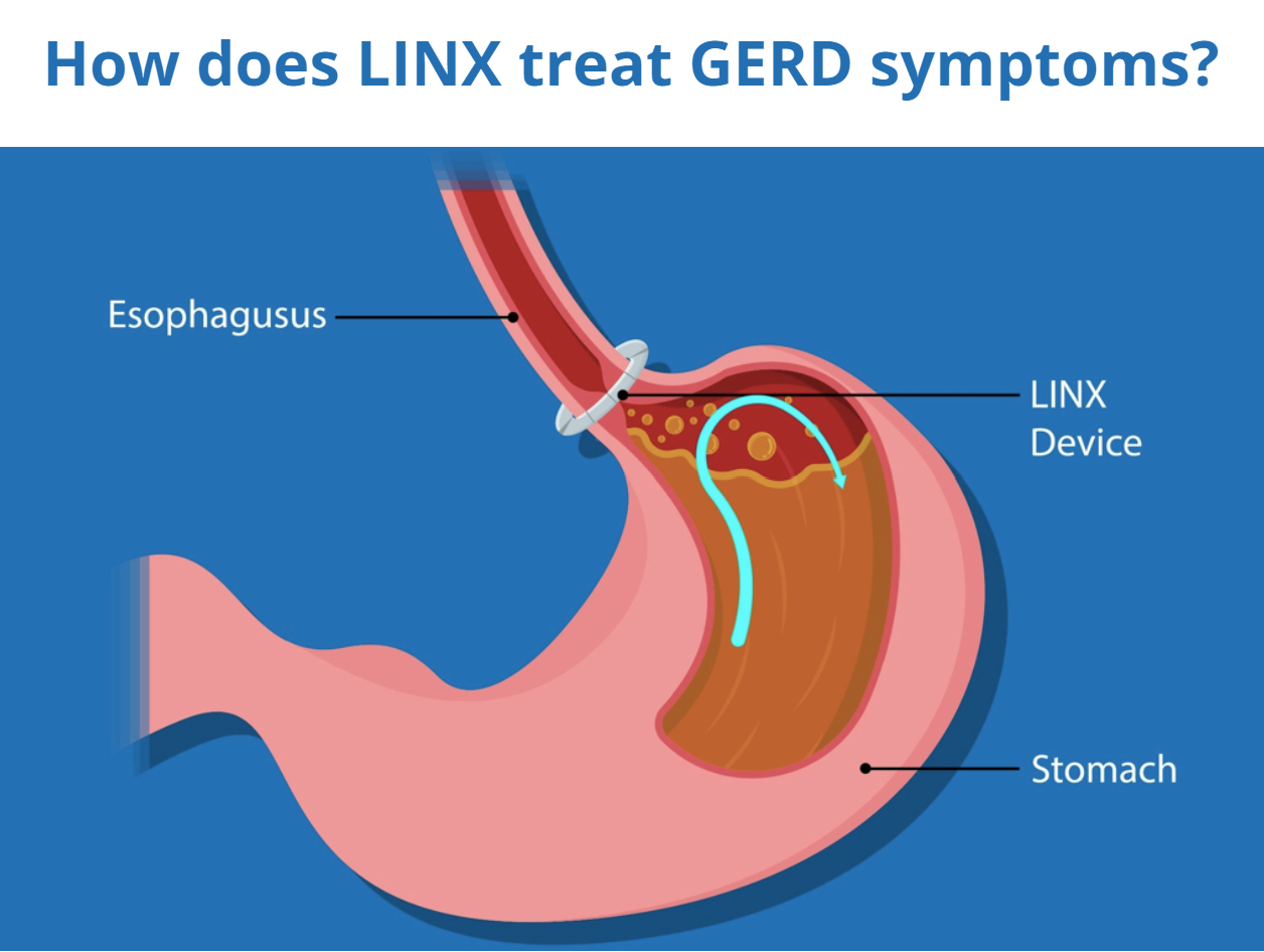 How does LINX treat GERD symptoms?