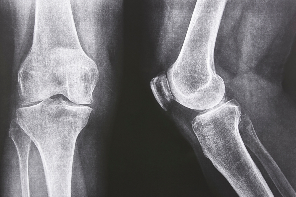 Judge Schedules First Federal Bellwether Exactech Knee Implant Trial for September 2025