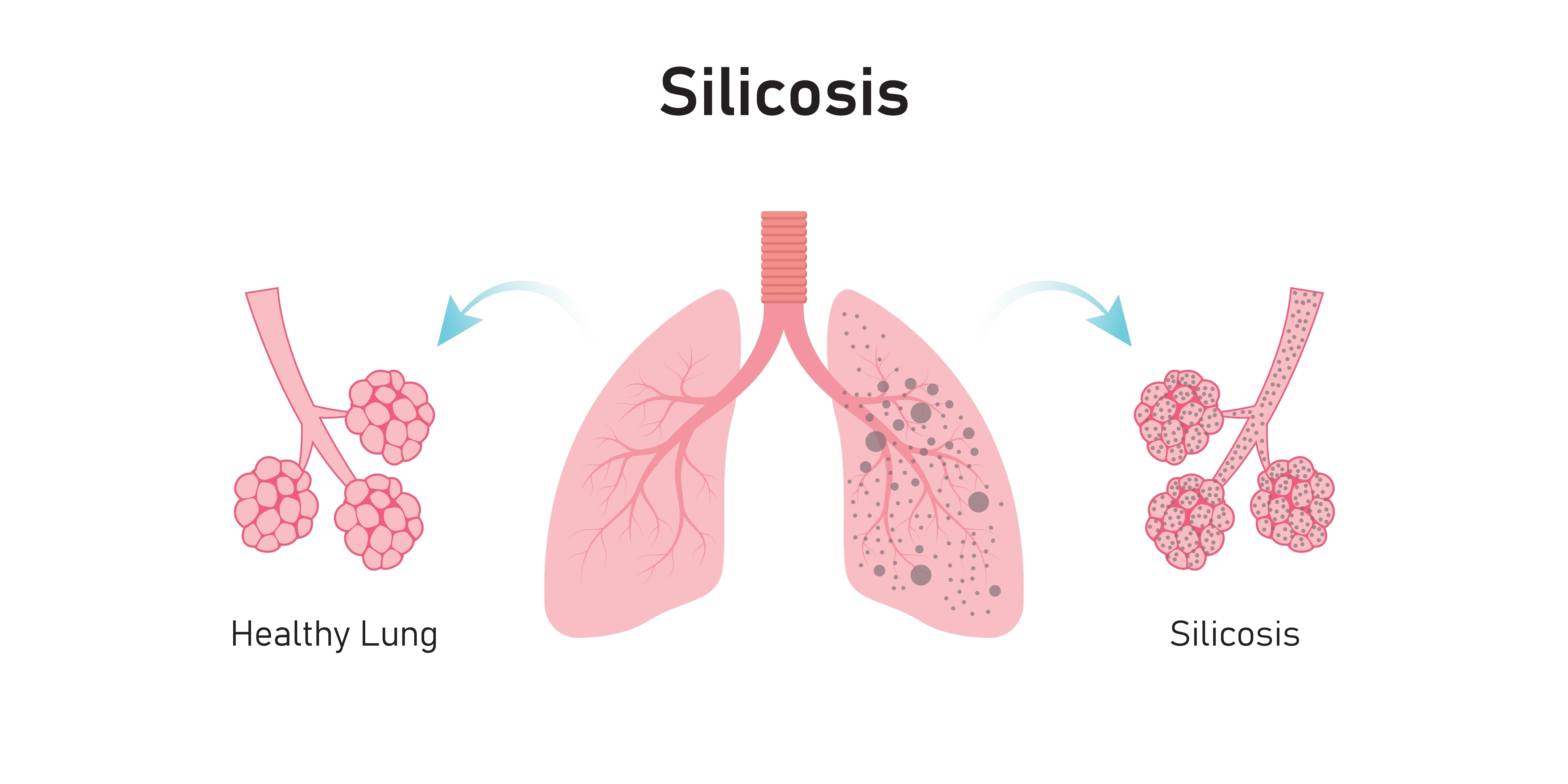 Stone-Fabricator-Silicosis-Side-Effects