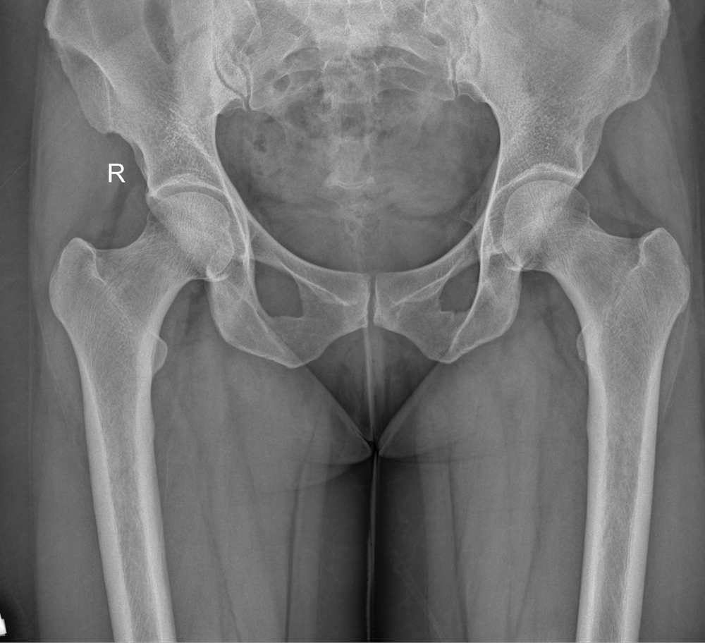 Zimmer Biomet CPT Hip System Linked to Increased Thigh Bone Fracture Risks, FDA Warns