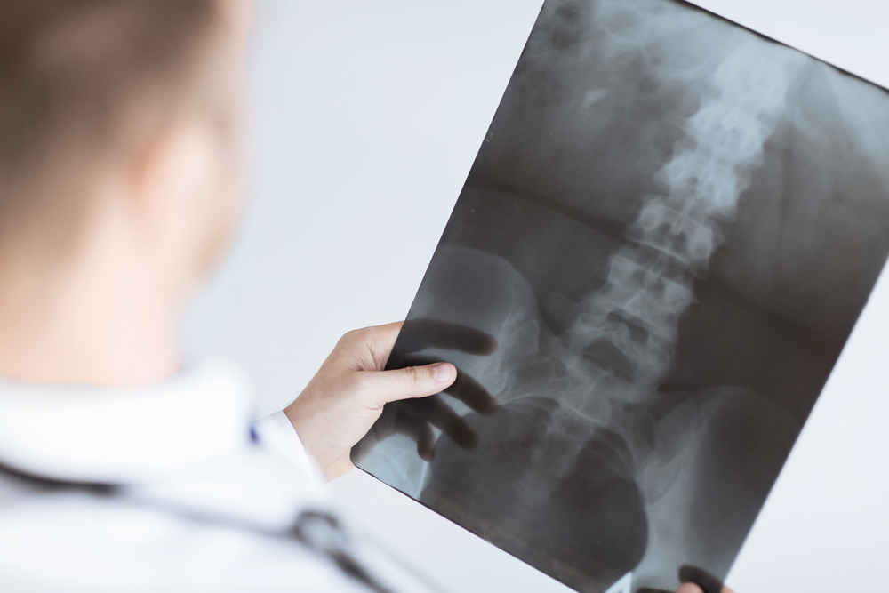 Prolia Discontinuation Increases The Risk Of Vertebral Fractures Study   Back Xray Ss 207938626 