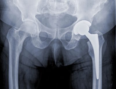 Hip Replacement Systems