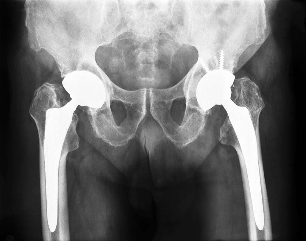 Stryker Hip Replacement Problems Result in Lawsuit Over LFit V40 Femoral  Head - AboutLawsuits.com