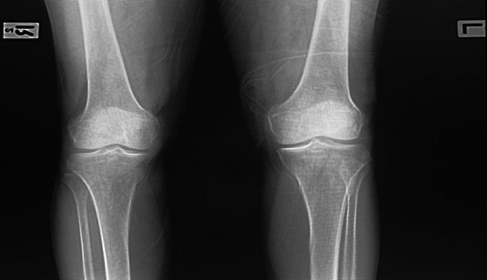 DePuy Attune Knee Failures Focus of Talking Points For Sales Reps ...