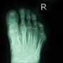 Cartiva Recall Lawsuit Alleges Failed Toe Implant Had To Be Surgically Removed Days Before Manufacturer Acknowledged Defect