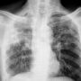 Chest X-Rays May Not Be Enough for Silicosis Diagnosis, Study Warns