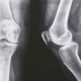 Judge Schedules First Federal Bellwether Exactech Knee Implant Trial for September 2025