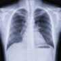 Keytruda, Similar Cancer Drugs May Increase Risk of Pulmonary Embolism: Study