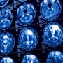 Lawsuit Alleges Depo-Provera Caused Intracranial Meningioma Brain Tumors