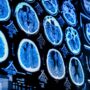 Mild Traumatic Brain Injuries Linked to Depression-Like Side Effects: Study