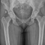 Zimmer Biomet CPT Hip System Linked to Increased Risk of Thigh Bone Fractures, FDA Warns